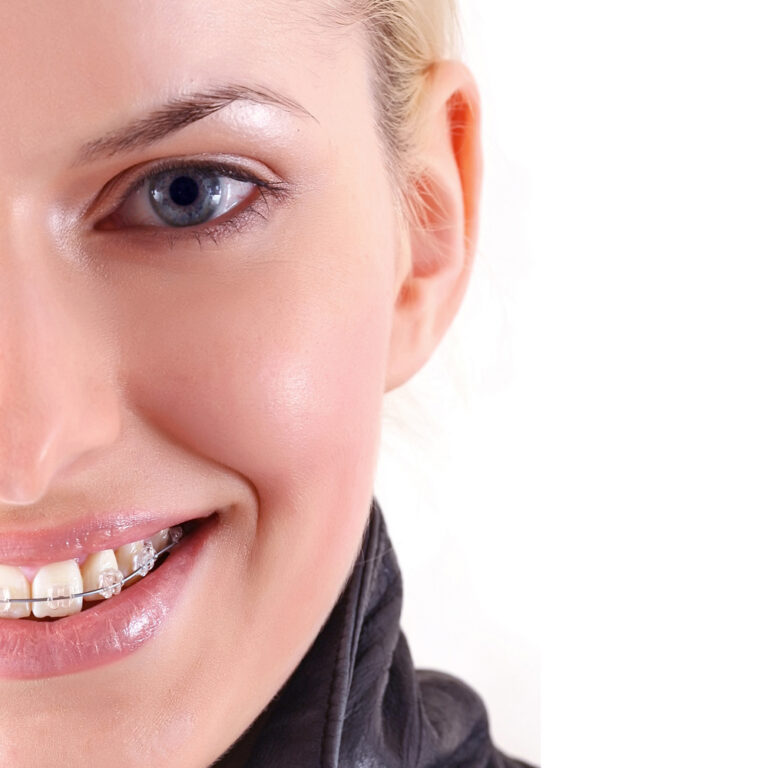 Braces Chiang Orthodontics Sunnyville, Ca Braces